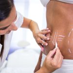 Close-up of surgeon drawing lines on womans abdomen for liposuction and cellulite removal