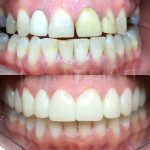 lentes_coroas_clareamento_48kb-5b88be07